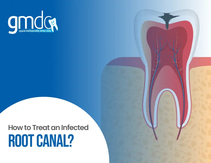 Root Canal